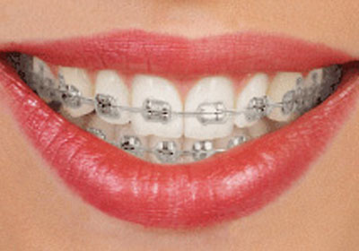 Traditional Metal Braces Bangalore