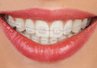 Clear (Ceramic) Braces Bangalore