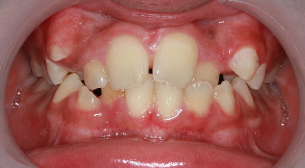 Orthodontist bangalore