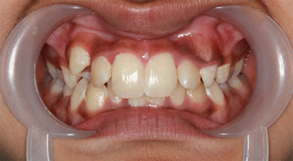 Orthodontist bangalore