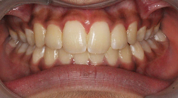 Orthodontist bangalore