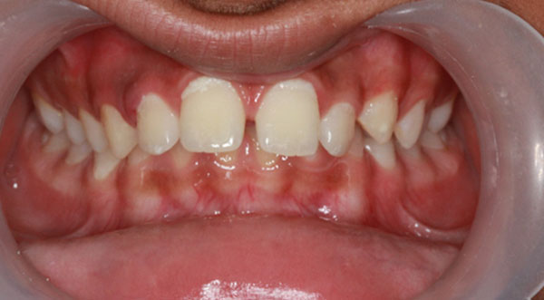 Orthodontist bangalore