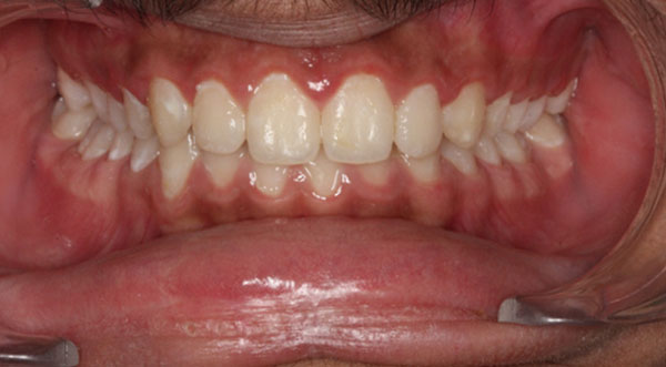 Orthodontist bangalore