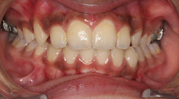 Orthodontist bangalore