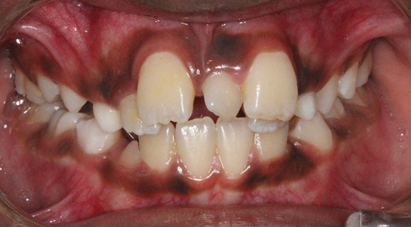 Orthodontist bangalore