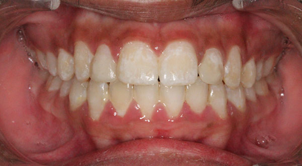 Orthodontist bangalore