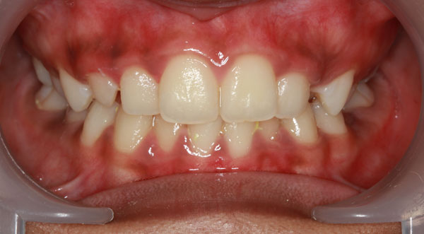 Orthodontist bangalore